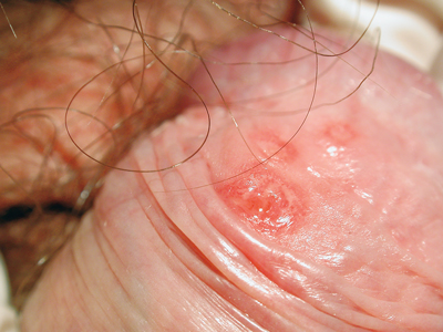 herpes genitale maschile uomo herpes genitale maschile uomo